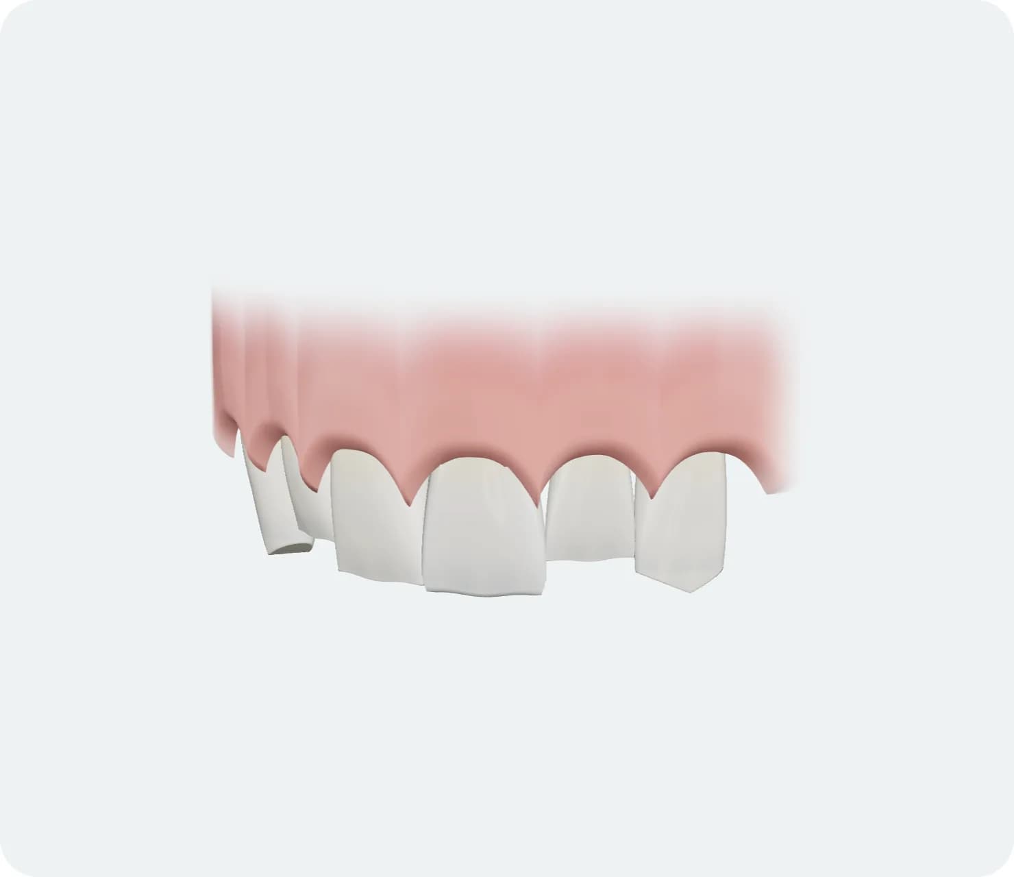 İllüstrasyon: Lamina Veneer, tedavi sonrası