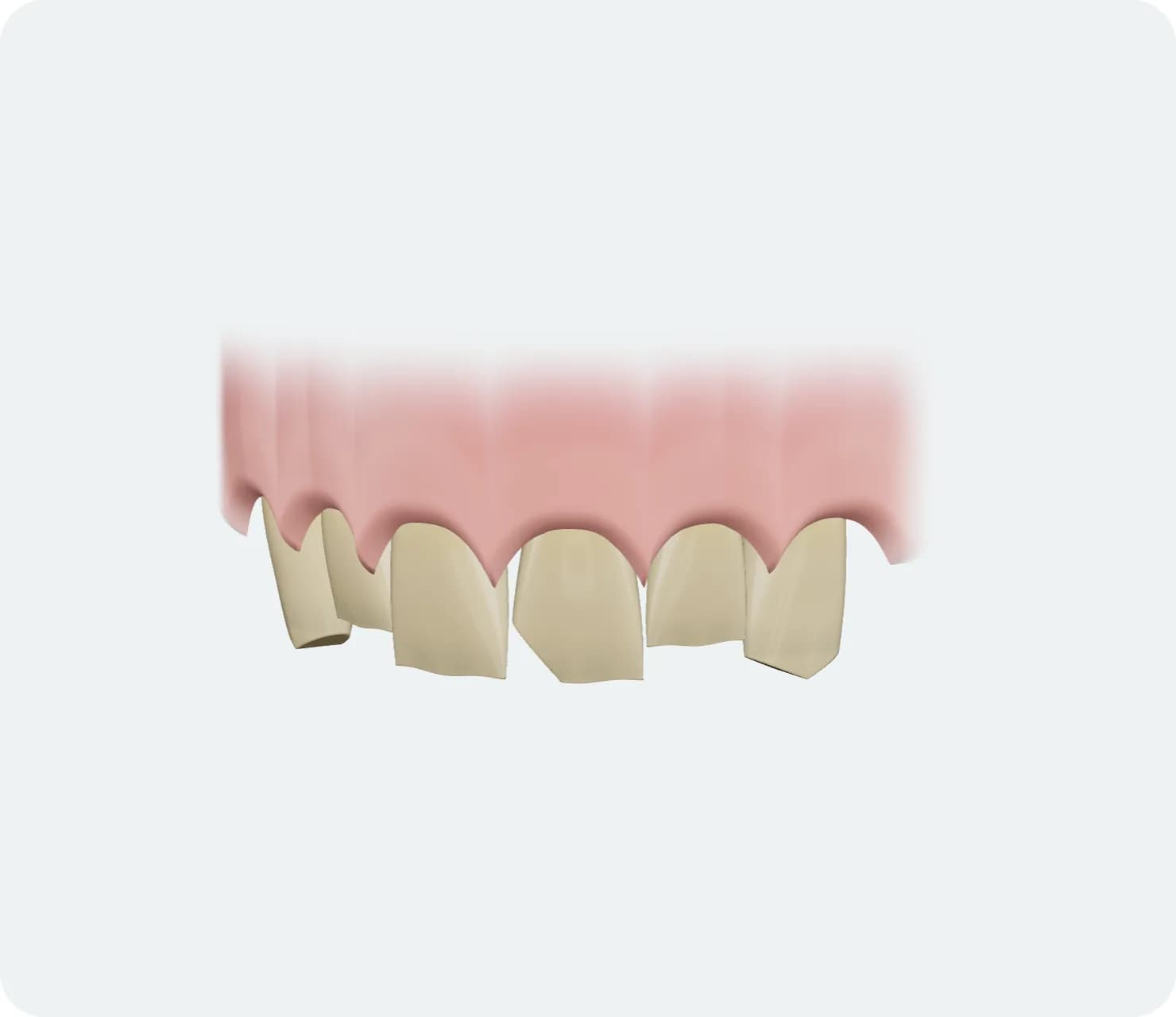 İllüstrasyon: Lamina Veneer, tedavi öncesi